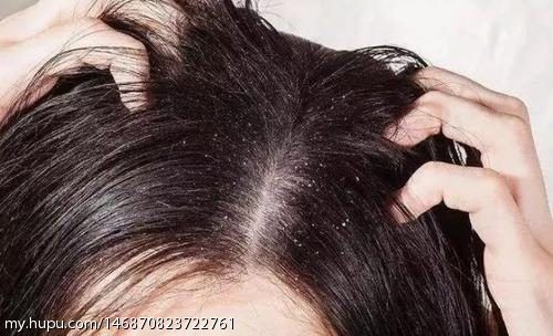 头皮瘙痒可能引起脱发,主要因为八种原因引起,要对症防治.