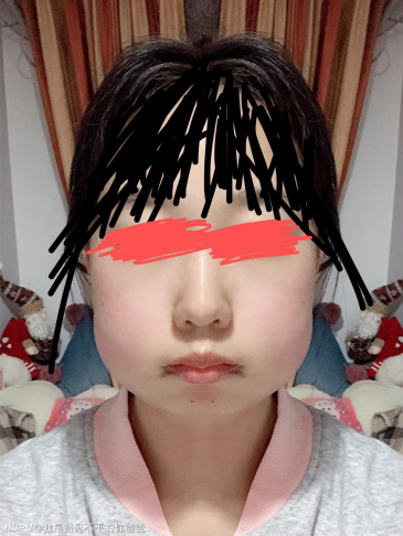 这个图是我用美图秀秀做了镜像对称,实际上我是一边脸肿成这样