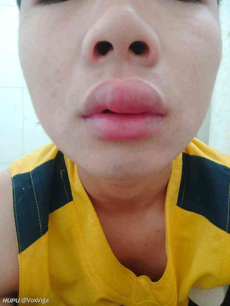 嘴被蚊子咬了如何快速消肿