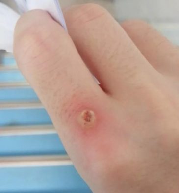 手上长了个瘊子今天刚做完第一次冷冻图片引起轻微不适