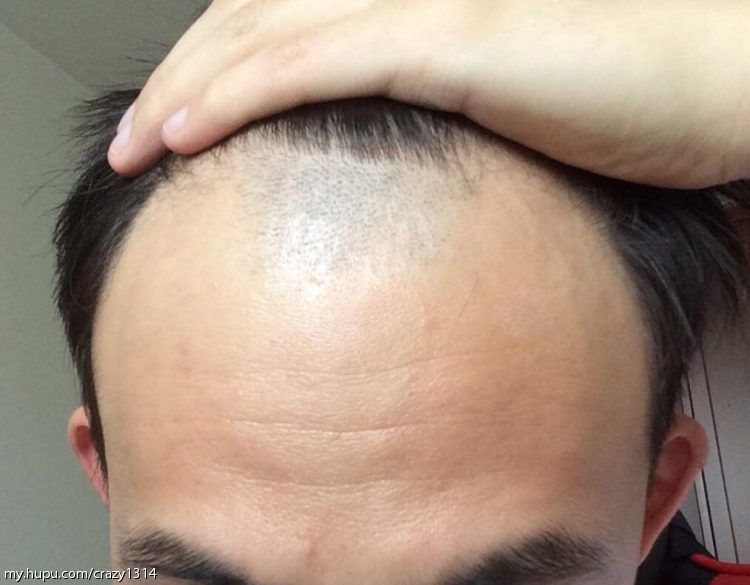 tony老师用一种匪夷所思的方式拯救了我的发际线.