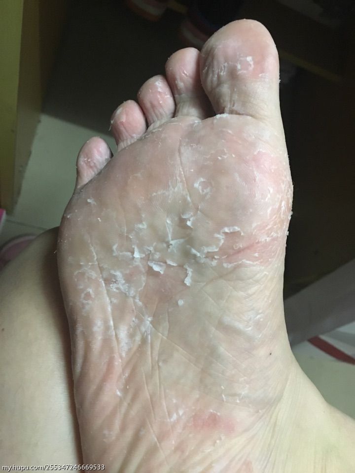 患有脚气是怎样的一种体验?(有图慎点)