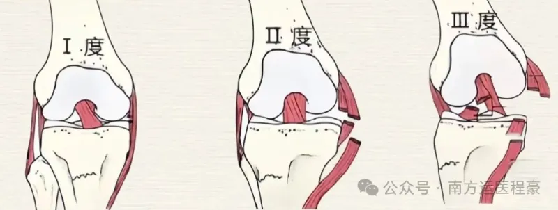 有一种膝关节扭伤叫内侧副韧带损伤(图3)