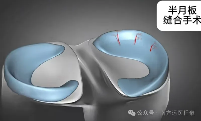 半月板缝合医生想告诉你的大实话(图1)