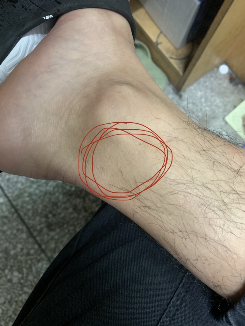 Xdm 打了球这个位置痛 有知道什么问题的吗 虎扑