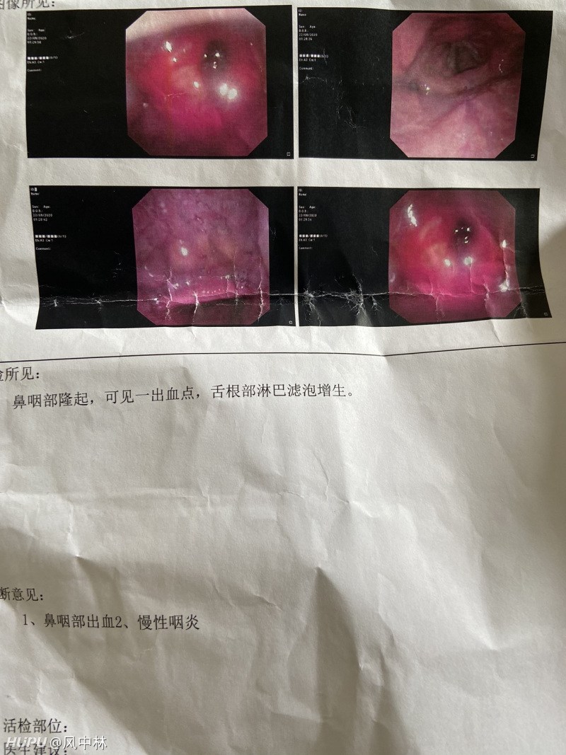 有耳鼻喉科的医生吗 请教一下这是什么病啊 虎扑