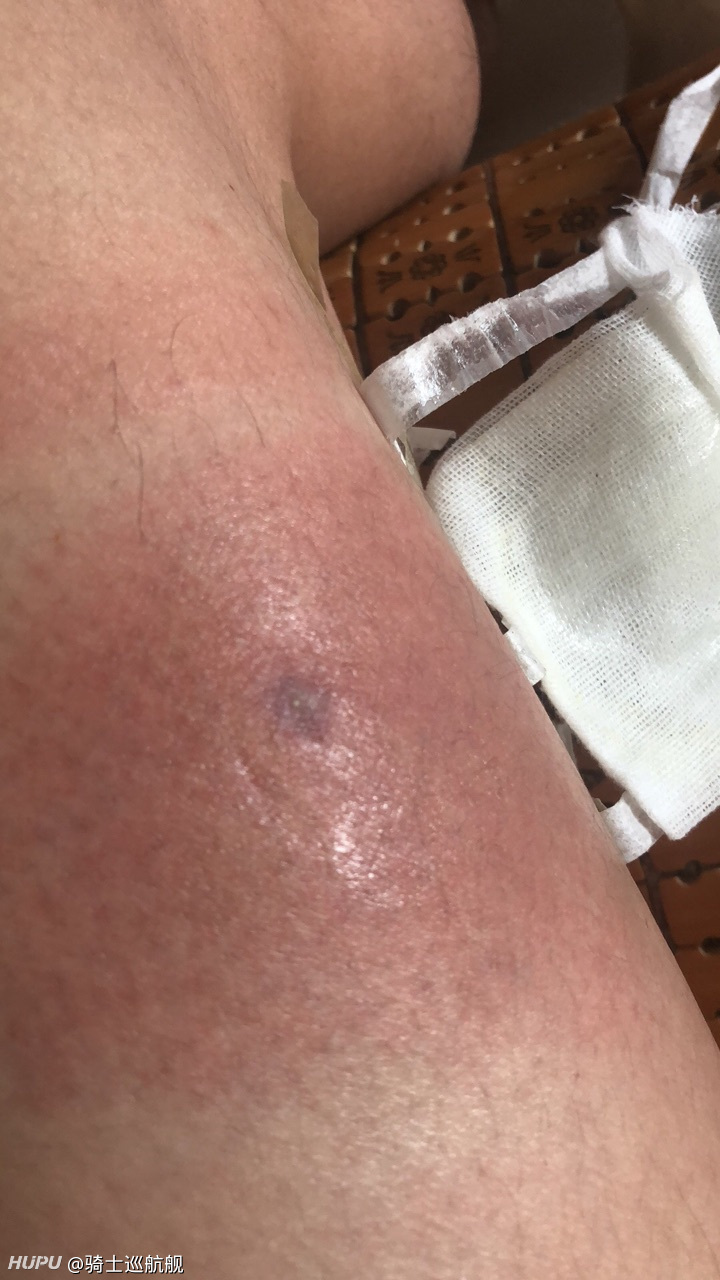 我是前几天被毒虫咬了的jr,昨天医院放了血情况终于好转