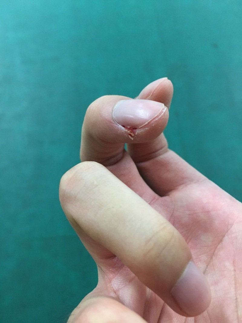 为啥每次打羽毛球,握拍手的中指都会出血
