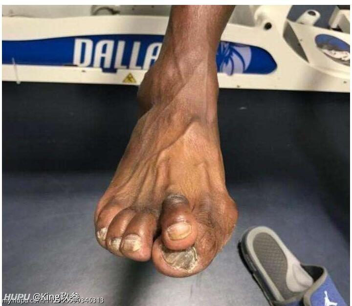 我知道lbj有拇外翻病症,没想到会这么严重了,这明显