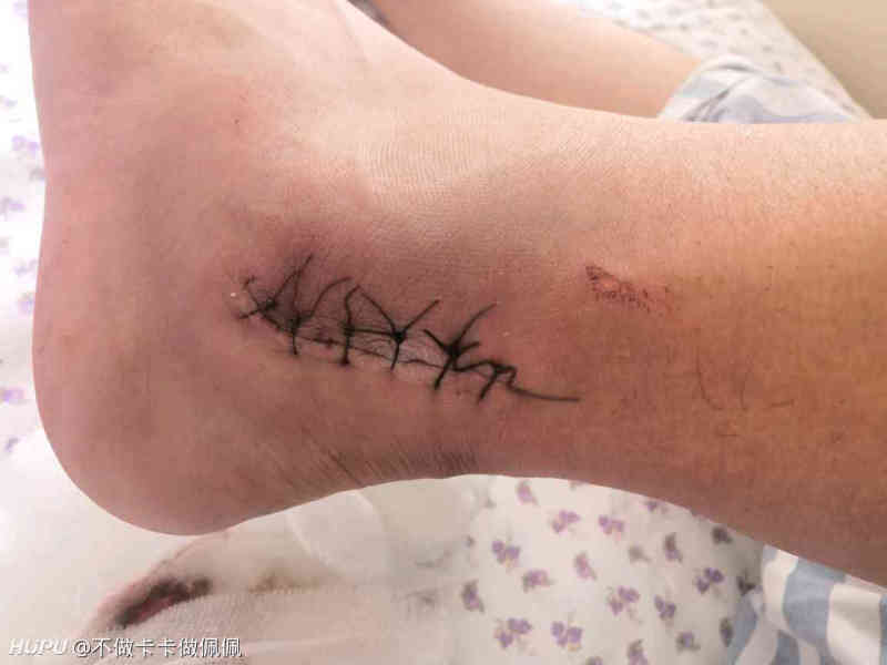 腓骨肌腱滑脱术后第二天