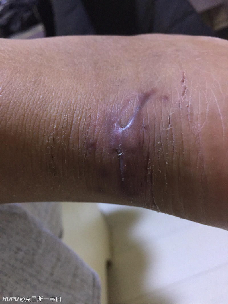 脚脖跟腱受伤,今天又抻了一下,有图慎入.