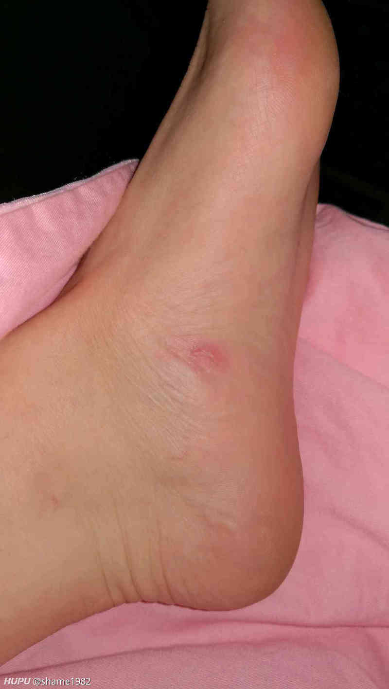 疼死了.这几天走路都疼. 2只脚都磨. 第一场就破皮.