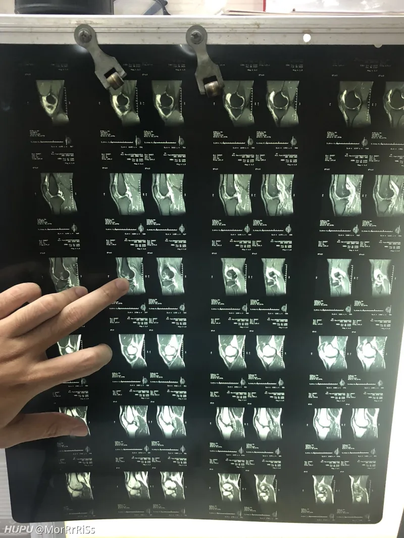 左腿3年两跟腱手术 退役篮球了 湿乎乎的话题 虎扑社区 左腿3年两跟腱手术 退役篮球了 湿乎乎的话题 虎扑社区