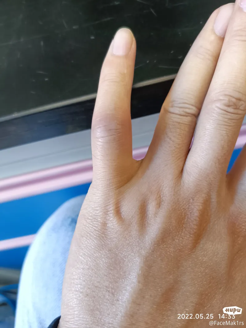 打球手指错位,一个月还能恢复吗?