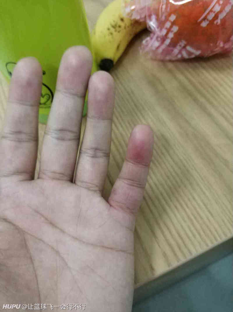 打球小手指戳歪了,自己掰回来了,现在怎么处理
