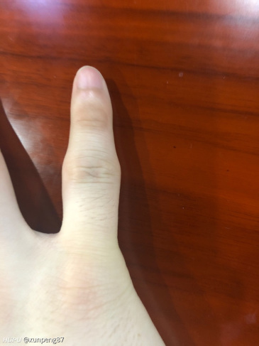 小拇指不直了怎么办