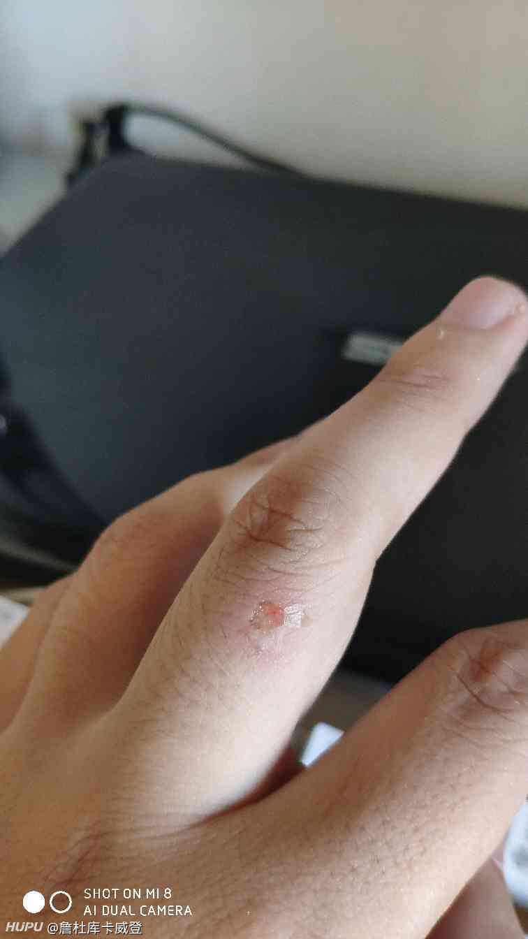 手指被烟头烫了该咋办?