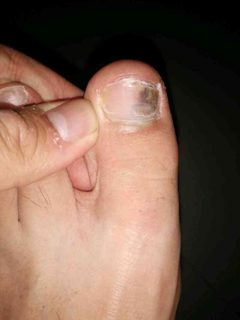 脚趾盖淤青了!