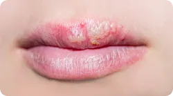 嘴巴起泡可能是疱疹病毒感染